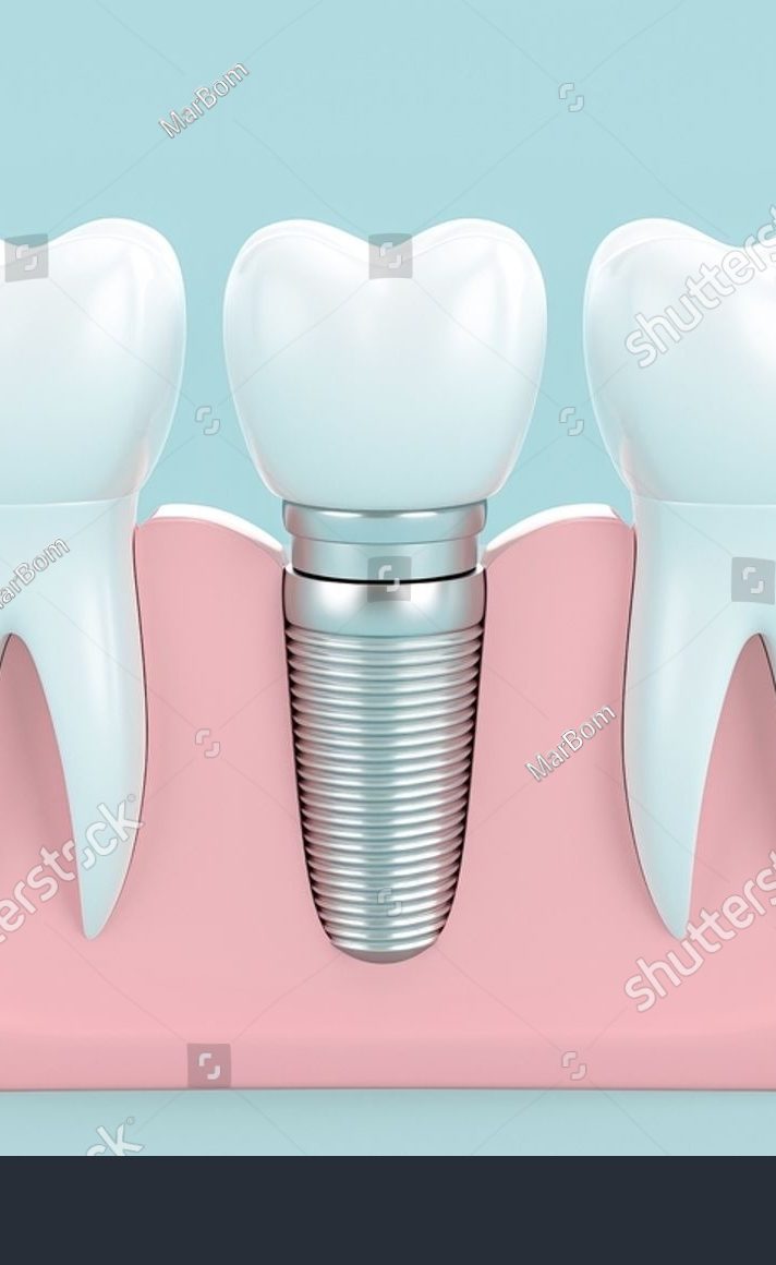 implant dentaire 92 